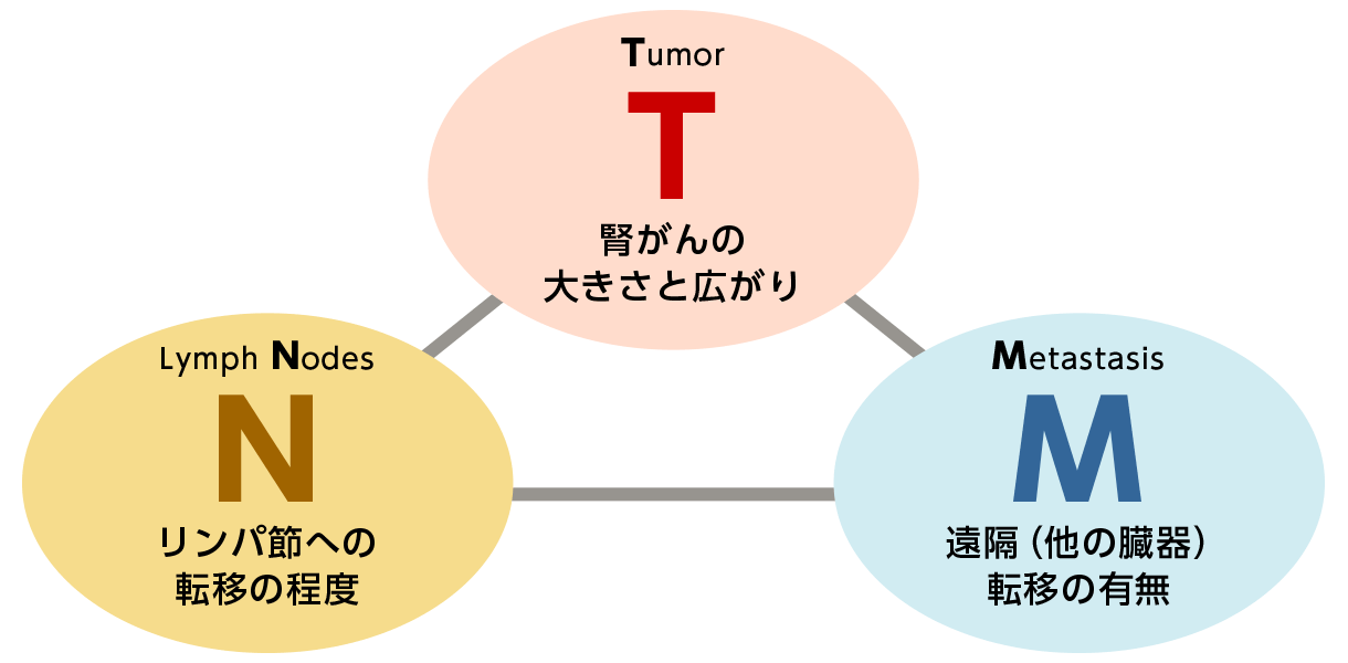 図2：腎がんの進行度（病期分類/TNM分類）