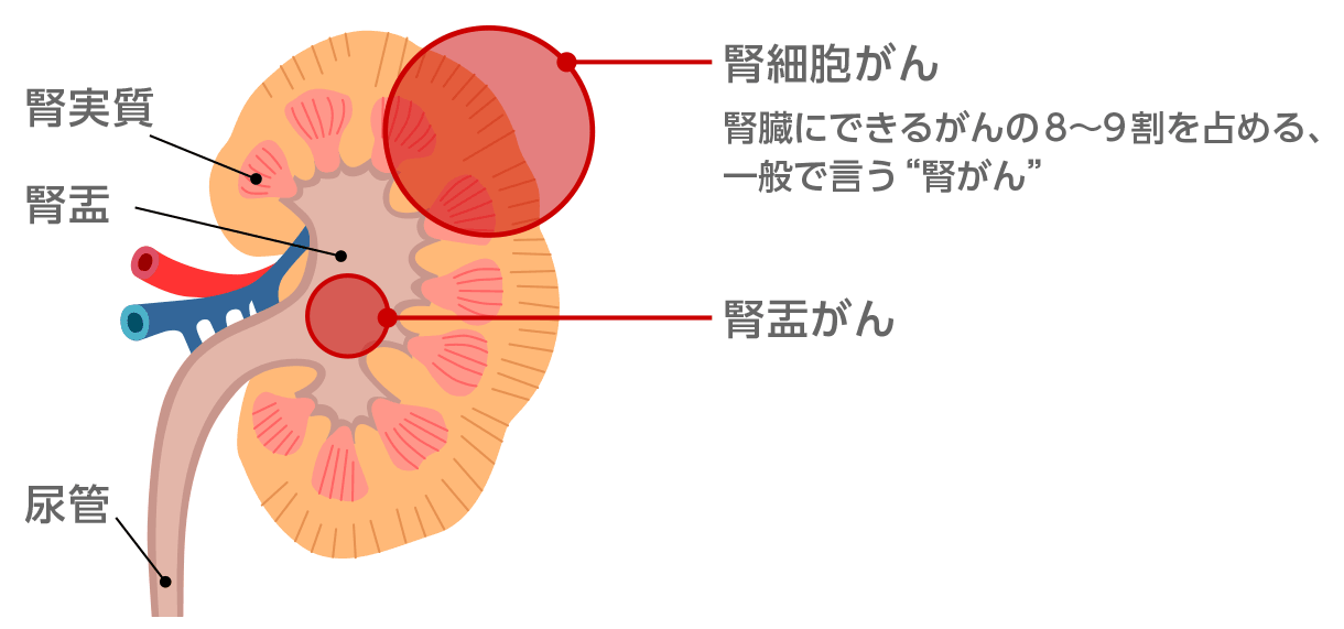 図1：腎実質に発生する腎細胞がん
