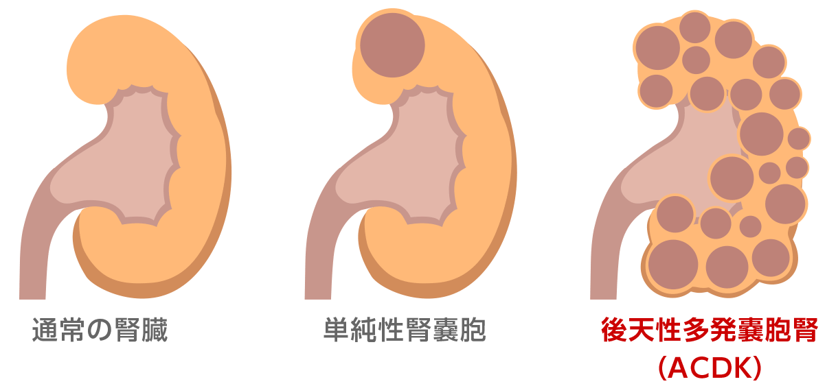 図5：後天性多発嚢胞腎（ACDK）イメージ