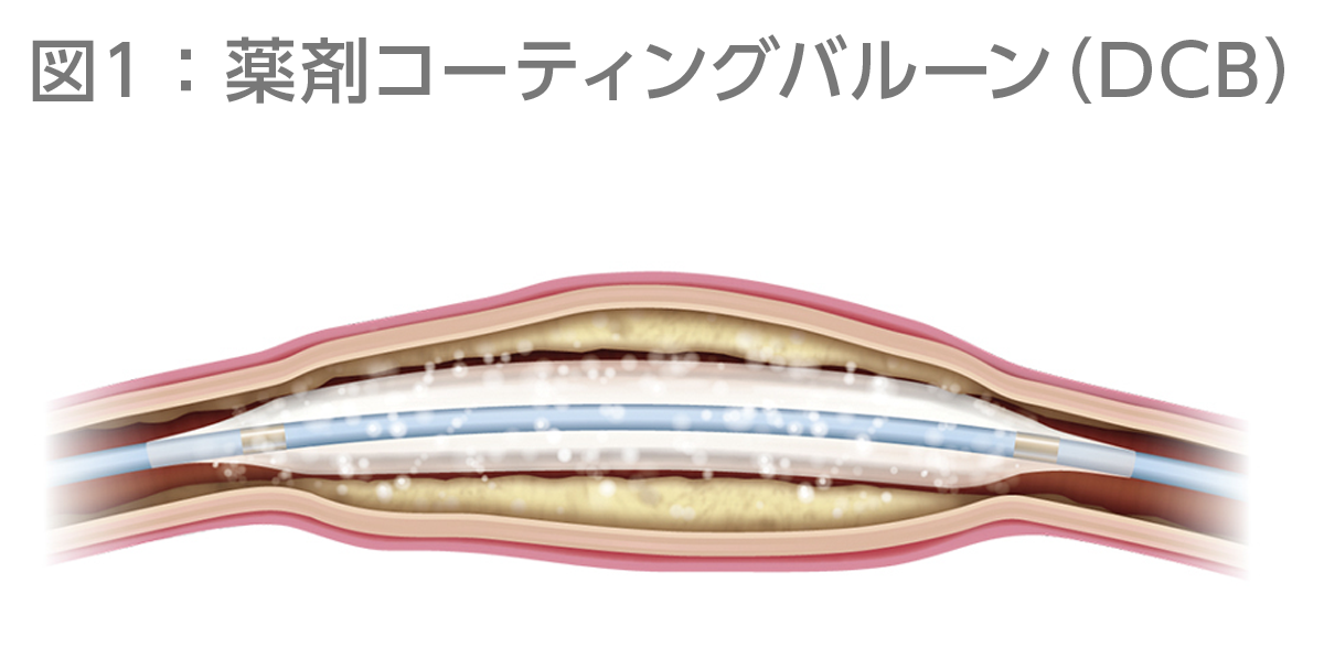 図1：薬剤コーティングバルーン（DCB）